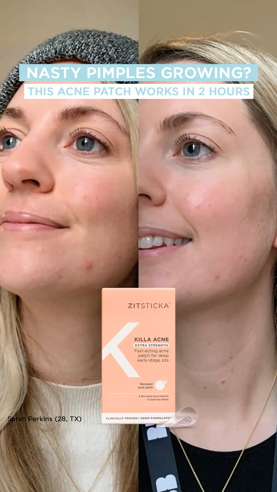 ZitSticka Statics Beauty 1